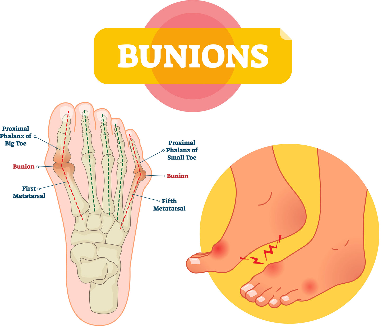 Bunion Protector
